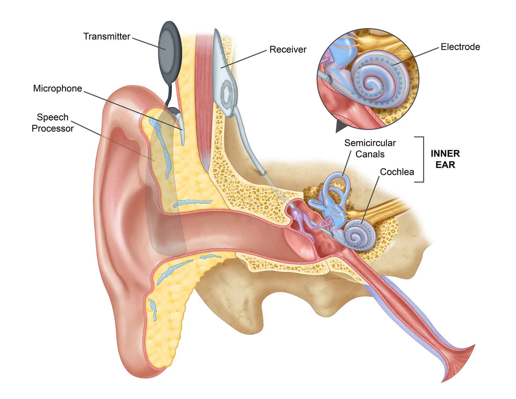 Hear system. Кохлеарный аппарат. Кохлеарный имплант кохлеар. Кохлеарная часть внутреннего уха.