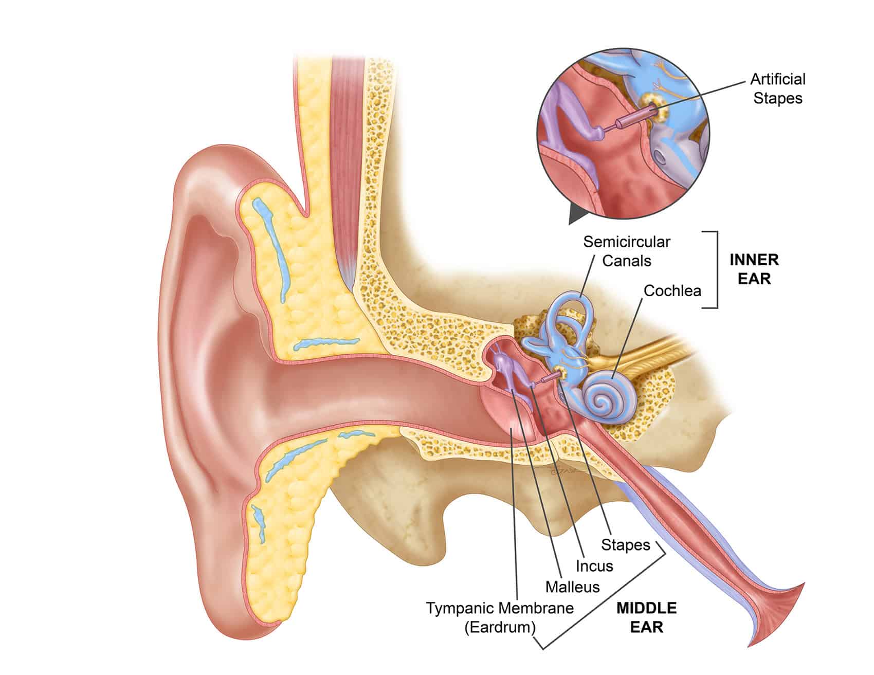 Otosclerosis and stapes surgery — Hearing Institute