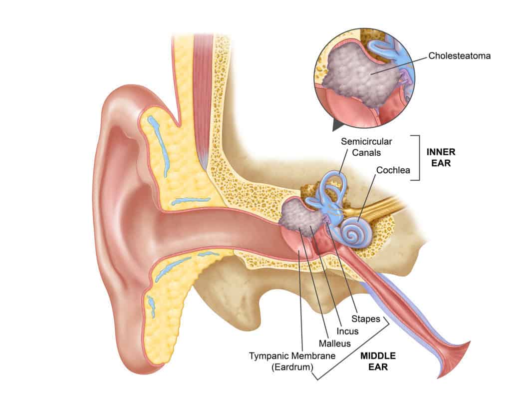 Cholesteatoma