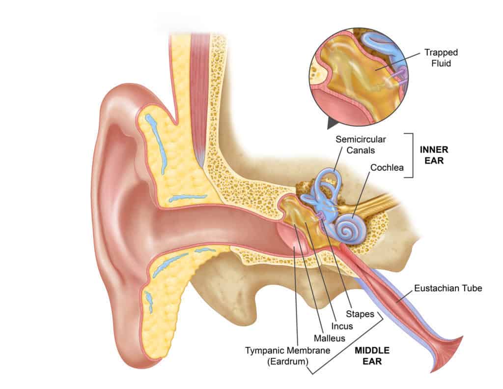 Otitis Media