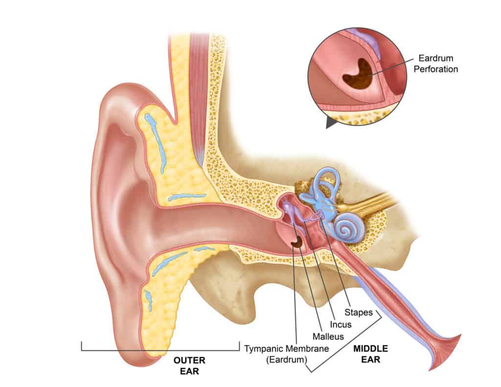 Perforated Eardrum