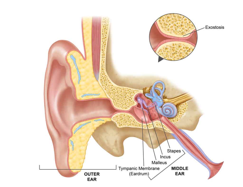 Exostosis